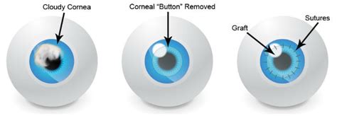 Keratoconus Surgery Rochester, NY | Cornerstone Eye Associates