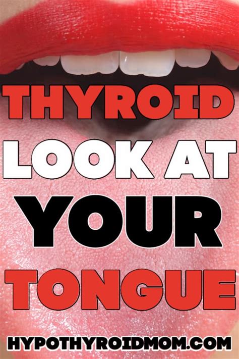 Thyroid Mouth, Teeth, Tongue, And Throat | Hypothyroid Mom