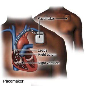 Pacemaker: Types and function