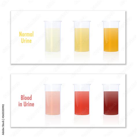 Blood In Urine Color Infographic Chart Blood in urine and normal urine in specimen cups, as ...