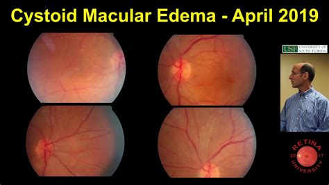 Macular Oedema