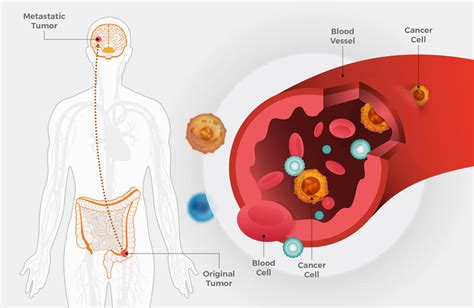 CIENCIASMEDICASNEWS: Metastatic Colorectal Cancer May Spread Early - National Cancer Institute