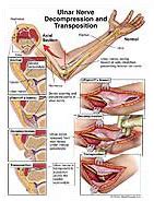 Ulnar Nerve Decompression and Transposition Medical Illustration