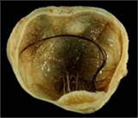 Primary Health Station: Ovarian Cysts: When to worry