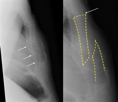 Sternal fracture - Radiology at St. Vincent's University Hospital