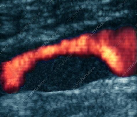 Atheroma plaque, Doppler ultrasound - Stock Image M175/0297 - Science Photo Library