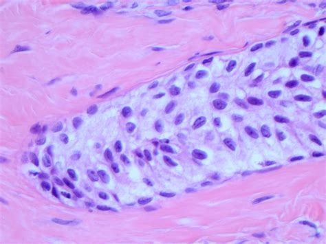 Pathology Outlines - Benign, borderline and malignant Brenner tumors