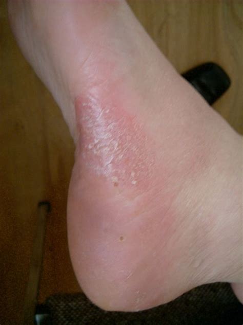 Blisters on feet can be due to eczema, psoriasis, or fungal infections