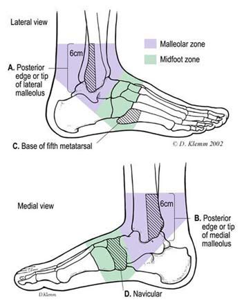 Ottawa Ankle Rule Archives - Jeffrey Sterling, MD