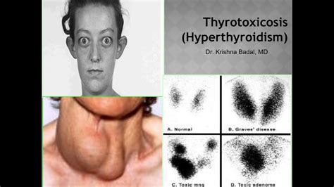 Thyrotoxicosis (hyperthyroidism) - YouTube