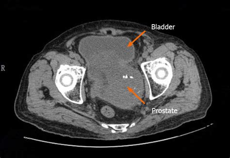 Prostate stromal tumor with prostatic cysts after transurethral resection of the prostate: A ...