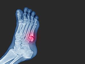 Fifth Metatarsal Base Fracture Classifications and Management