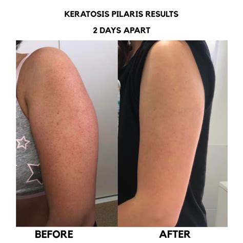 Keratosis Pilaris Treatment Results After 2 Days | Bangn Body