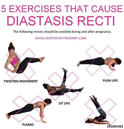 Can I Exercise With Diastasis Recti - Exercise Poster