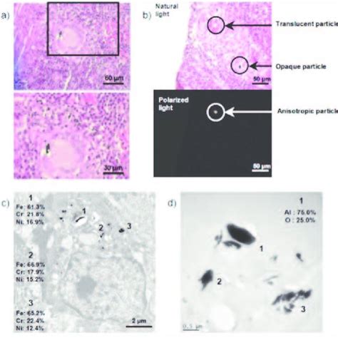 a) Photographs of histological section of the lung biopsy lymph node,... | Download Scientific ...