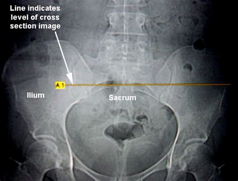 SI Joint Arthritis - Drwolgin