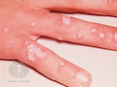 Warts | KidsHealth NZ