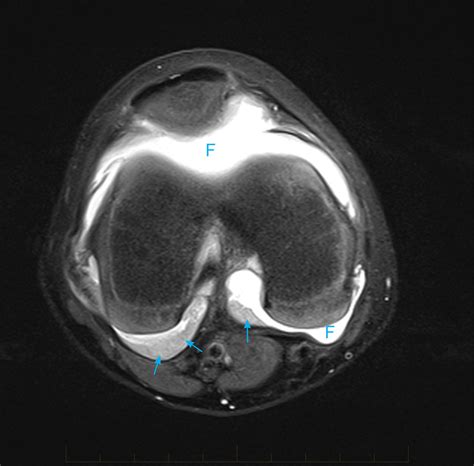 MRI Knee - Paediatic MRI Series - Clinical Cases - GP Referred MRI Scans