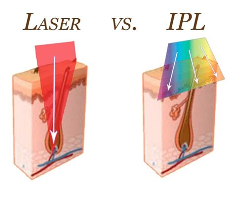 Laser vs Intense Pulsed Light (IPL) | Best Plastic & Cosmetic Surgery Clinic Dubai UAE