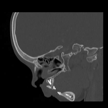 Dental trauma | Radiology Case | Radiopaedia.org