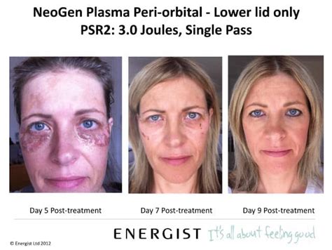 Neogen and Plasma Treatment | Lasting Impression Medical Spa