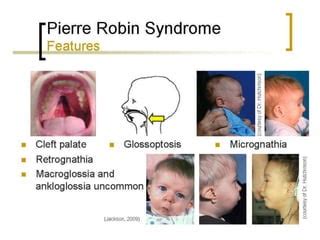 Pierre Robin Syndrome | PPT