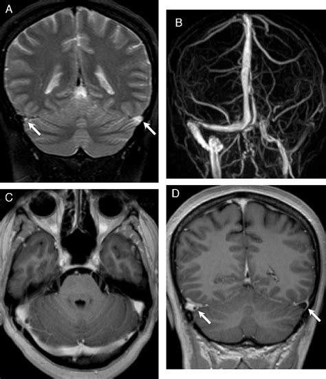 Figure 1 from MRI diagnosis of dural sinus—Cortical venous thrombosis: Immediate post-contrast ...