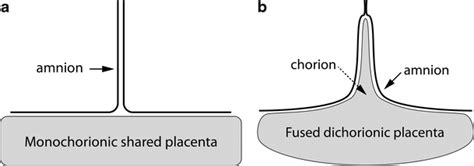 Diagrams illustrate the “T” and “lambda (λ)” signs in early pregnancy.... | Download Scientific ...