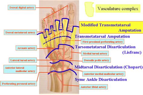 Amputation causes, types of amputation and amputation complications