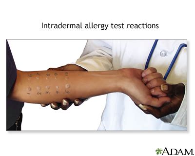 Allergy testing - skin | UF Health, University of Florida Health