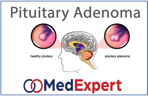 Pituitary Adenoma treatment options and causes | MED Expert