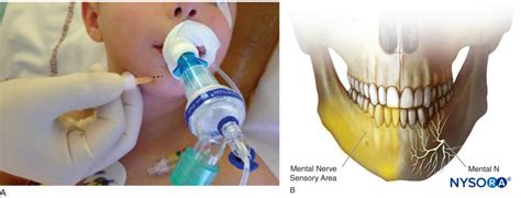 anestesia-regional-bloqueo-del-nervio-mental-zona-sensorial-del-nervio-mental - NYSORA | NYSORA