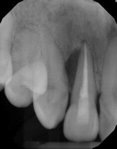 Diagnosis of Endodontic-Periodontal Lesions - Decisions in Dentistry