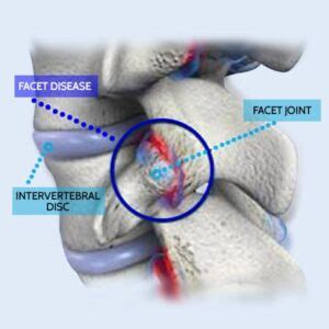 Facet Hypertrophy Treatment | Without Surgery Or Injections