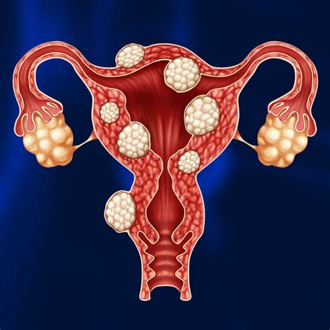 Uterine fibroids in women: why is it dangerous and how to treat it ...