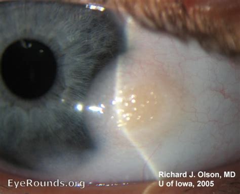 Goldenhar's Syndrome. EyeRounds.org: Online Ophthalmic Atlas