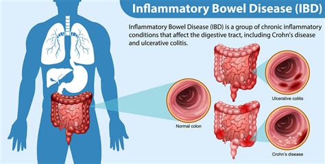 Inflammatory Bowel Disease