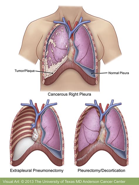 Mesothelioma Treatment | MD Anderson Cancer Center