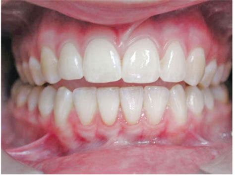 Words from our TMJ Expert: How do we treat Idiopathic Condylar Resorption?