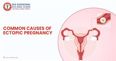 Common Causes of Ectopic Pregnancy