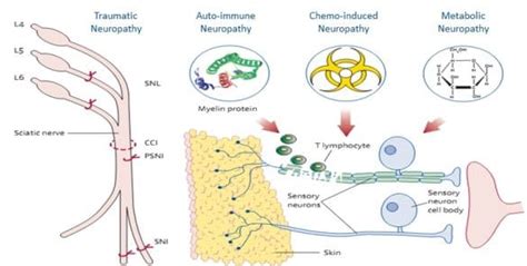 Neuropathic pain - ANS Biotech