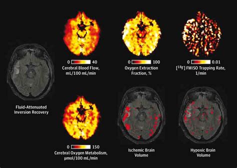 Evidence of Cerebral Ischemia Using Oxygen 15-Labeled Positron Emission ...