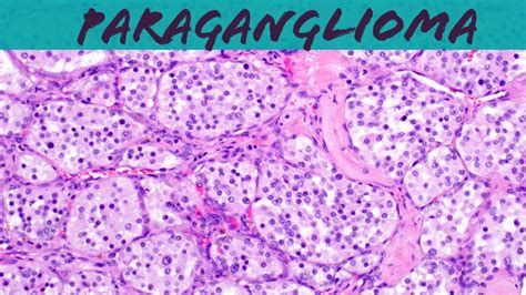 Paraganglioma (carotid body tumor) & Pheochromocytoma (explained in 5 ...