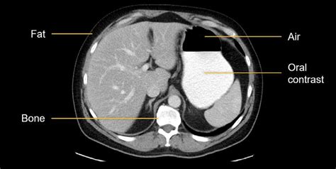 Abdominal CT: Attenuation • LITFL • Radiology library