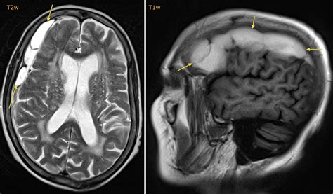 Subacute subdural haematoma - MRI - Radiology at St. Vincent's University Hospital