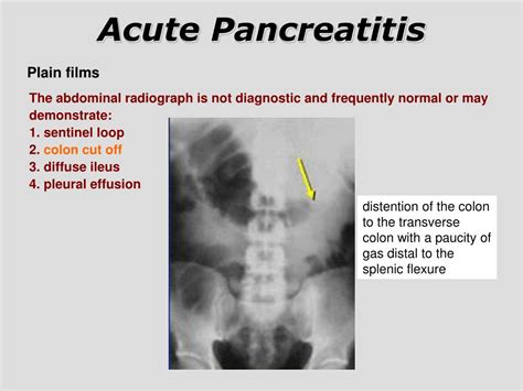 Sentinel Loop Pancreatitis Colon Cut Off Sign