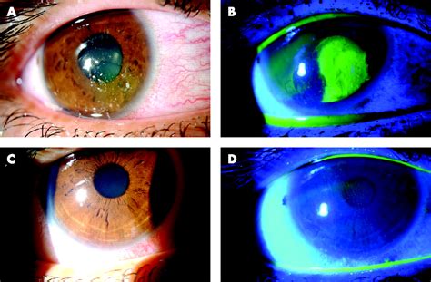 Alcohol delamination of the corneal epithelium for recalcitrant ...