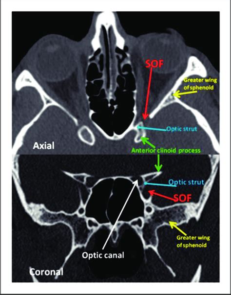 What Is The Orbit In Anatomy - Anatomical Charts & Posters