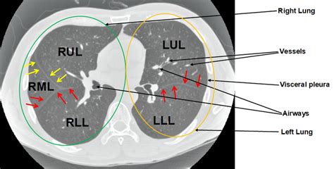 Figure A.1: An axial lung CT slice with visible fissures. The left ...