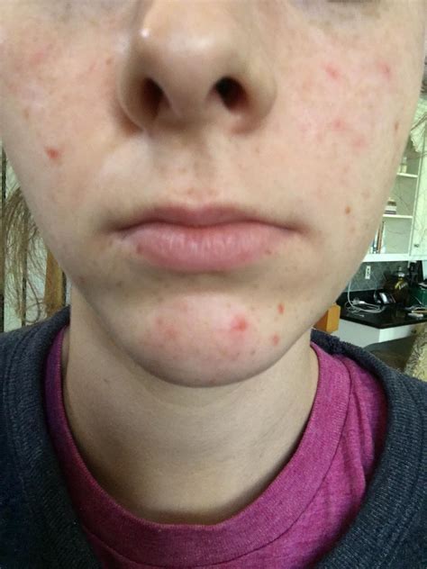 [routine help] fading acne scars on differin? : SkincareAddiction